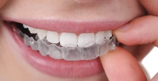 appareil dentaire en 3D