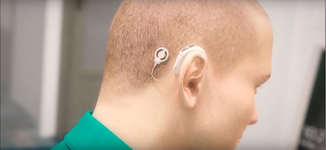 image une vidéo implant auditif Wyss Center