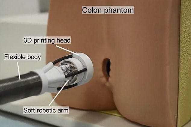 L'imprimante 3D injectable à introduire dans un orifice corporel